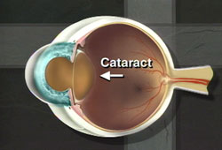 Cataracts