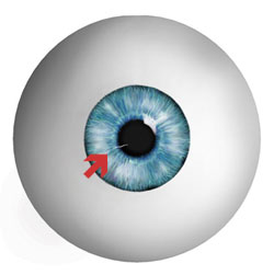 Corneal Abrasions